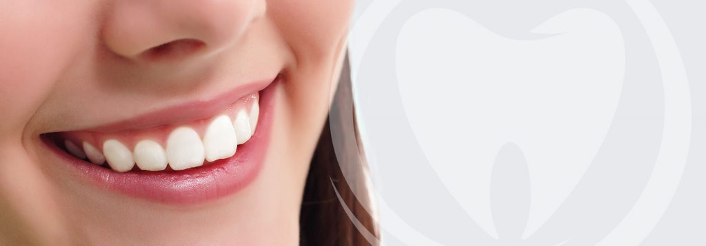 Porcelain veneers
