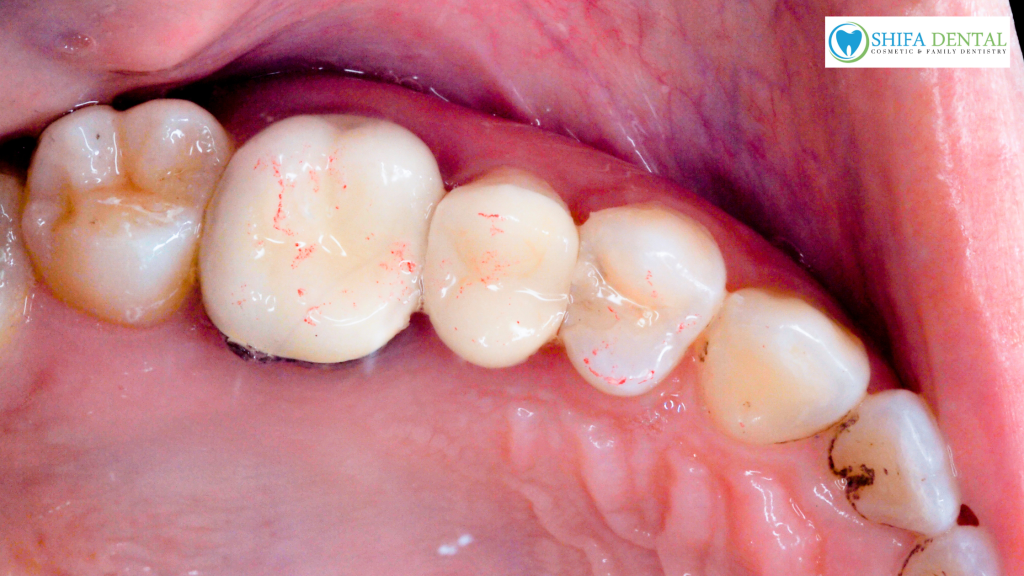 dental fillings in Garland TX