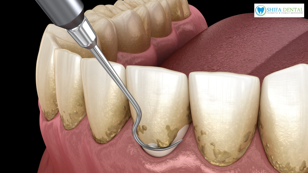 periodontal therapy in Garland TX