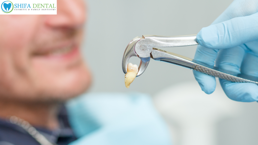 Tooth Extractions in Plano TX