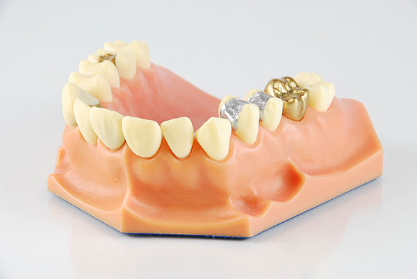 Tooth filling in Plano, TX | Tooth Filling in Garland, TX
