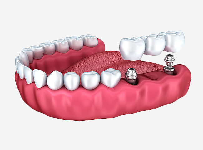 Dental crown in Plano & Garland, TX