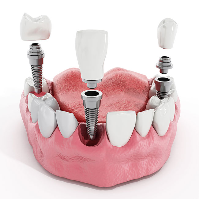 restorative-dentistry