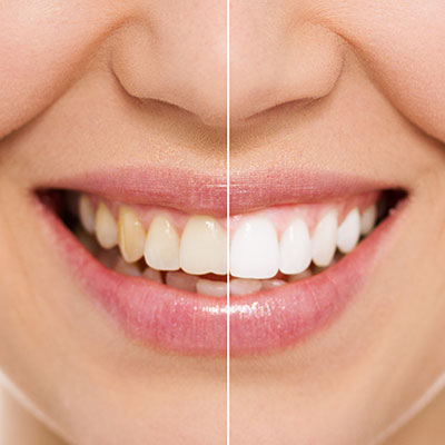 Teeth whitening in Plano, Tx | teeth whitening Garland, Tx