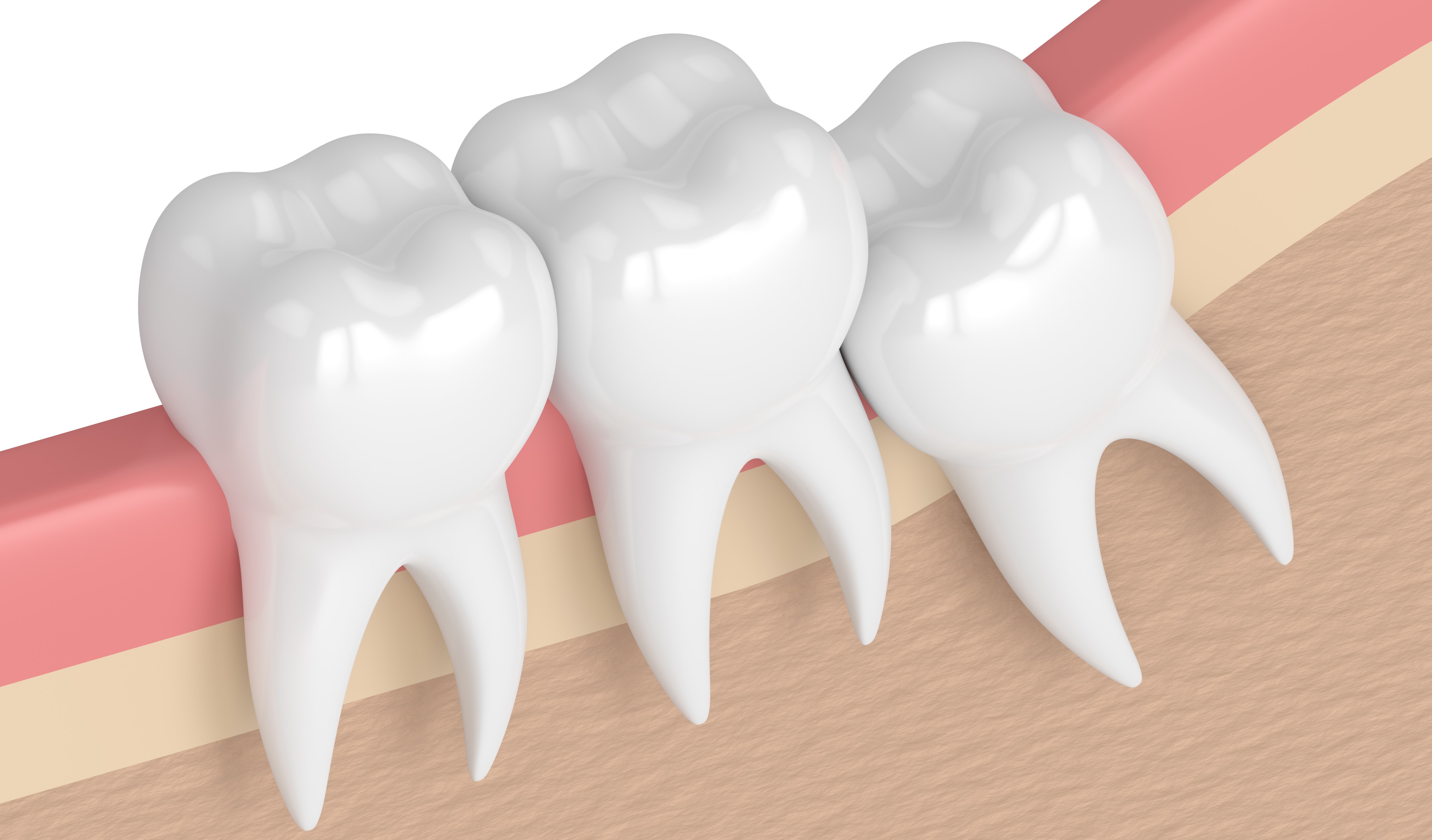 Dental extraction in Plano, Tx | Dental extraction in Garland, Tx