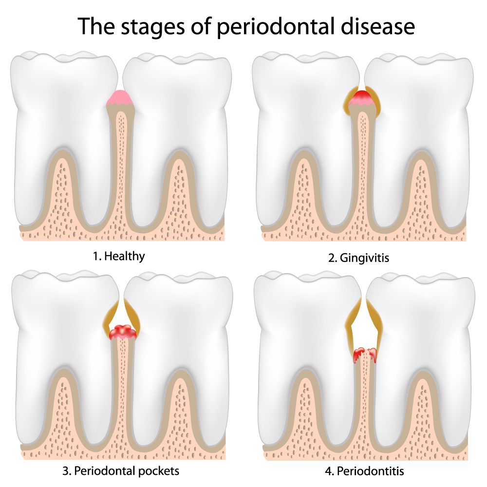 the stage of periontal disease