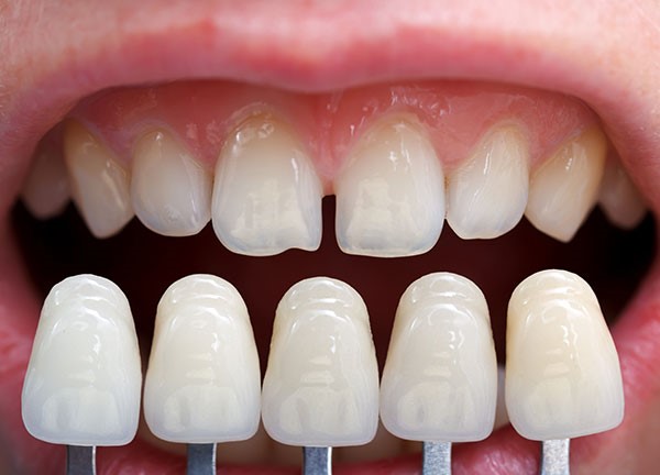 Dental Veener Dental Veneer Plano, TX | Dental Veneer Garland, TX