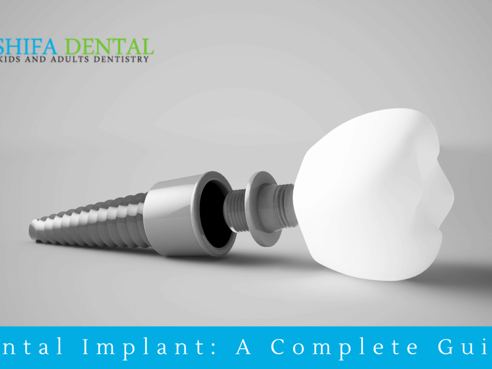 Dental Implant In Plano and Garland,TX