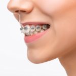 Metal Braces