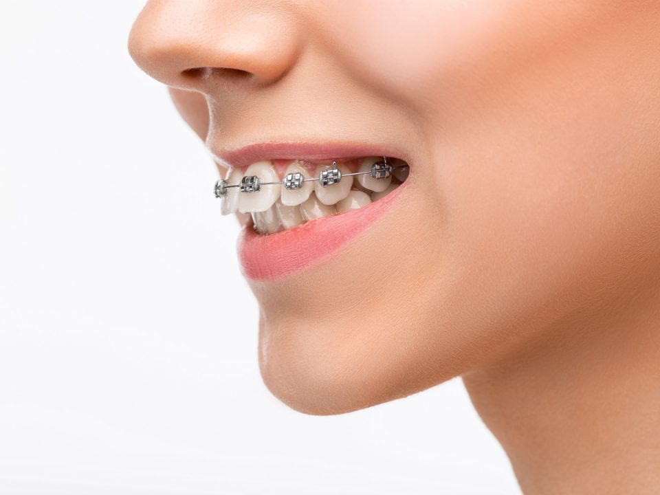 Metal Braces