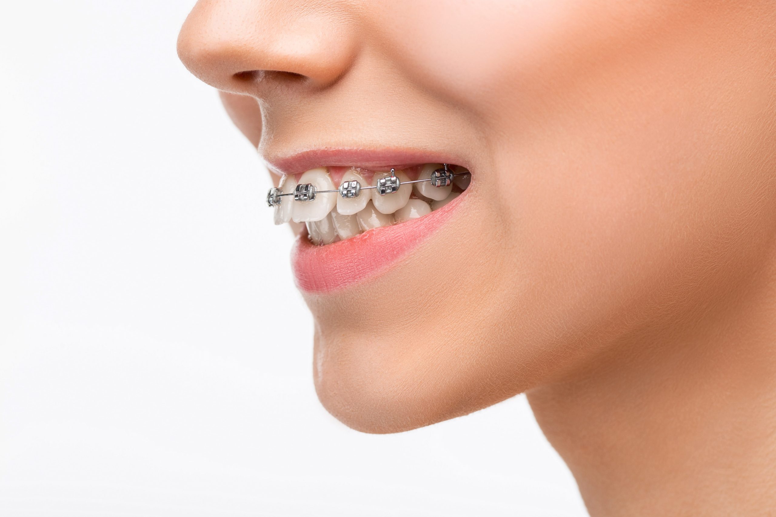 Metal Braces