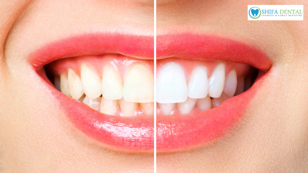 teeth whitening in Garland TX