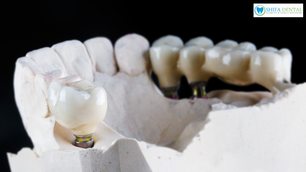 dental crowns in Garland TX