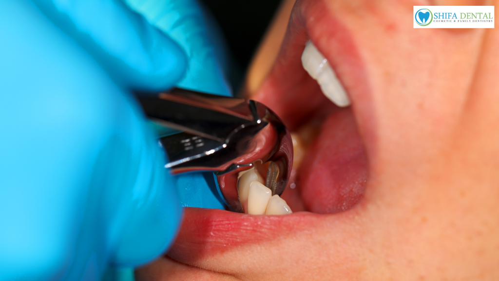 dental extractions in Garland TX