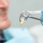 Dental Extractions in Plano