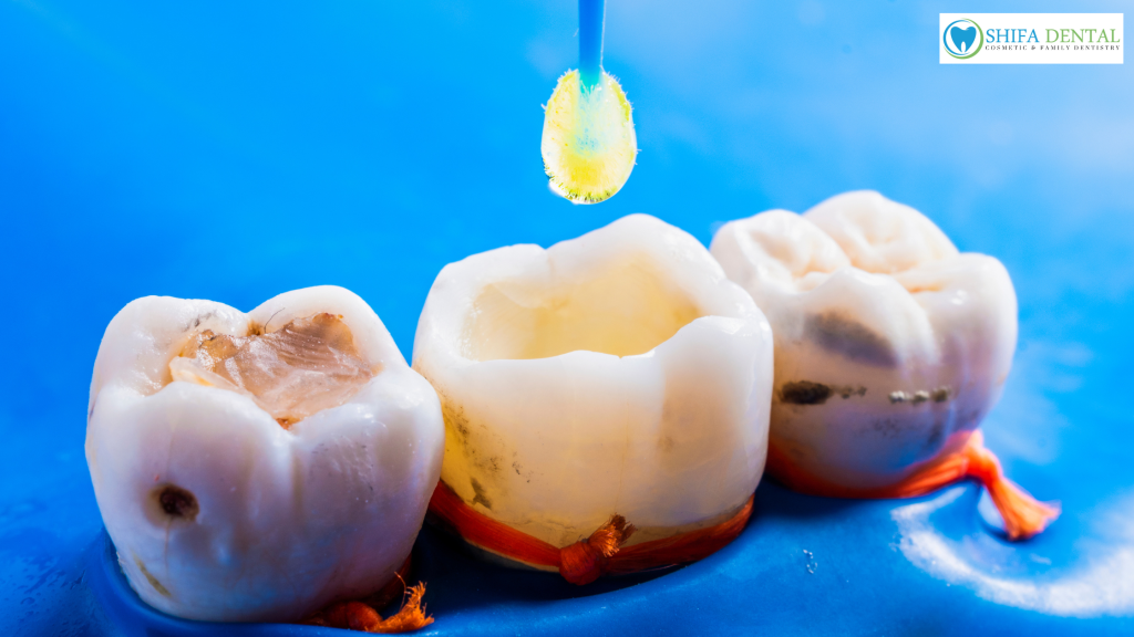dental fillings in plano TX