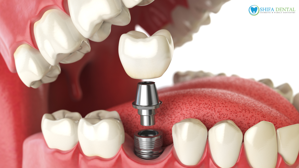 dental implants in plano TX