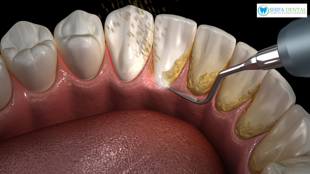 teeth cleaning in plano tx