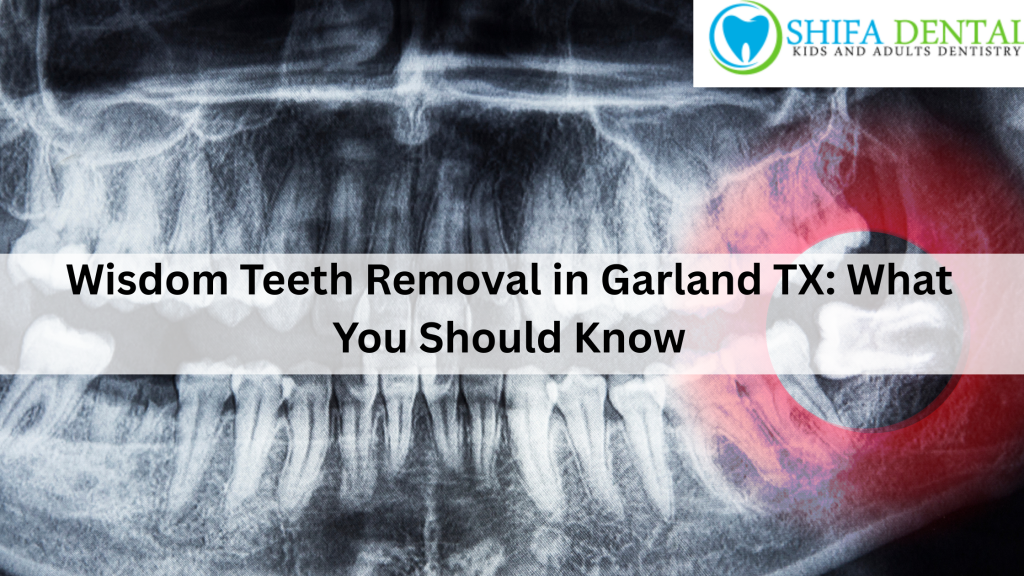 Wisdom Teeth Removal in Garland TX