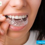 invisalign-vs-braces-plano