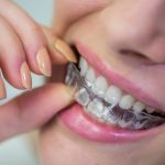 invisalign-clear-aligners-in-plano-tx