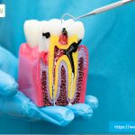 root-canal-therapy-garland-tx