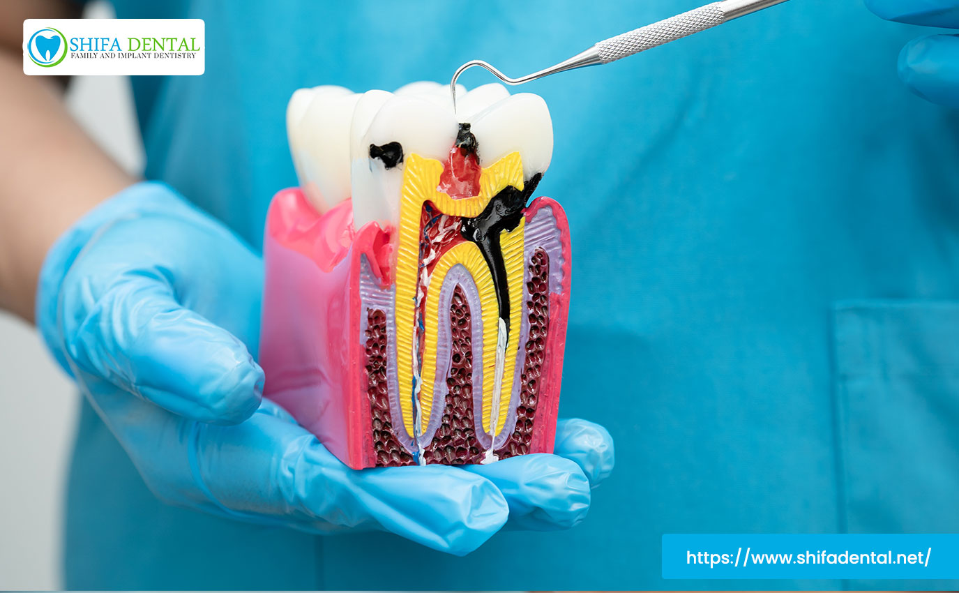 root-canal-therapy-garland-tx