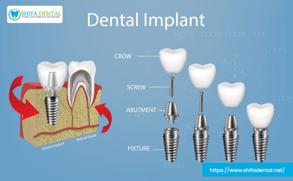 affordable-dental-implants-plano-tx