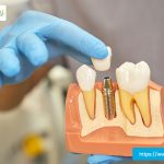 best-dental-implant-treatments-near-me