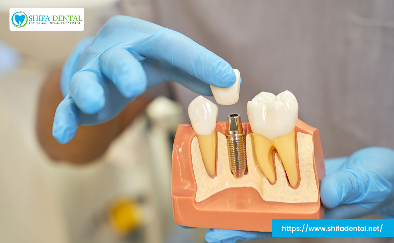 best-dental-implant-treatments-near-me