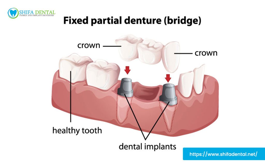 tooth-replacement-dental-implants