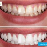 cosmetic-teeth-whitening