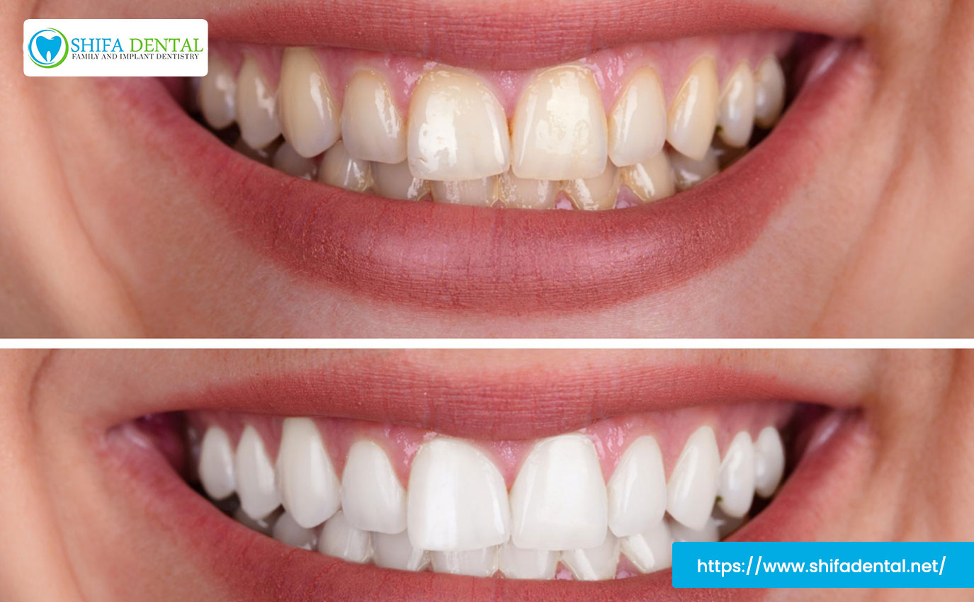 cosmetic-teeth-whitening