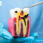 emergency-root-canal-plano