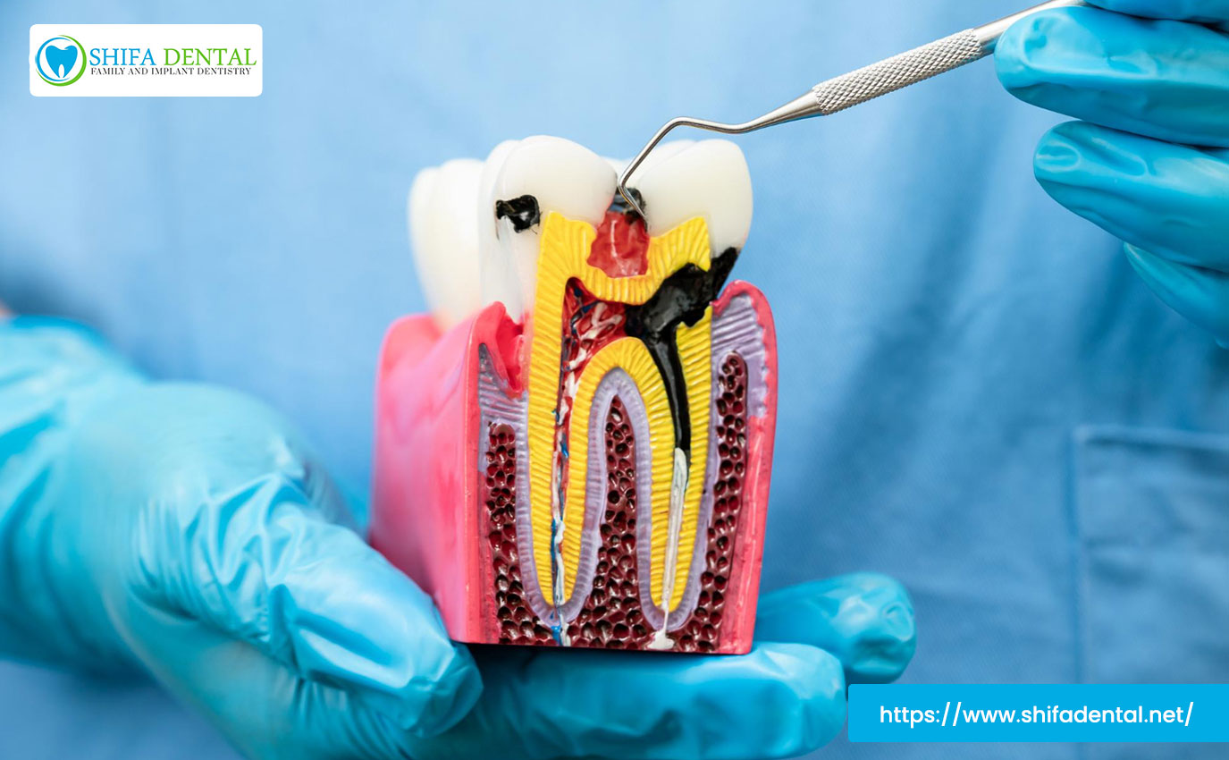 emergency-root-canal-plano