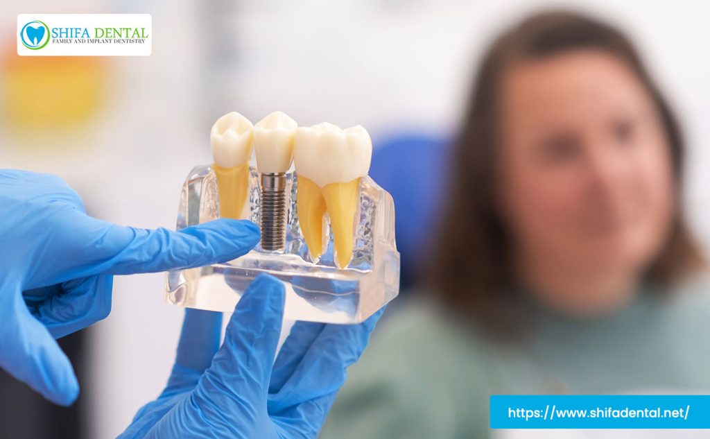 full-mouth-dental-implants-plano-tx