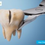 full-mouth-tooth-extraction