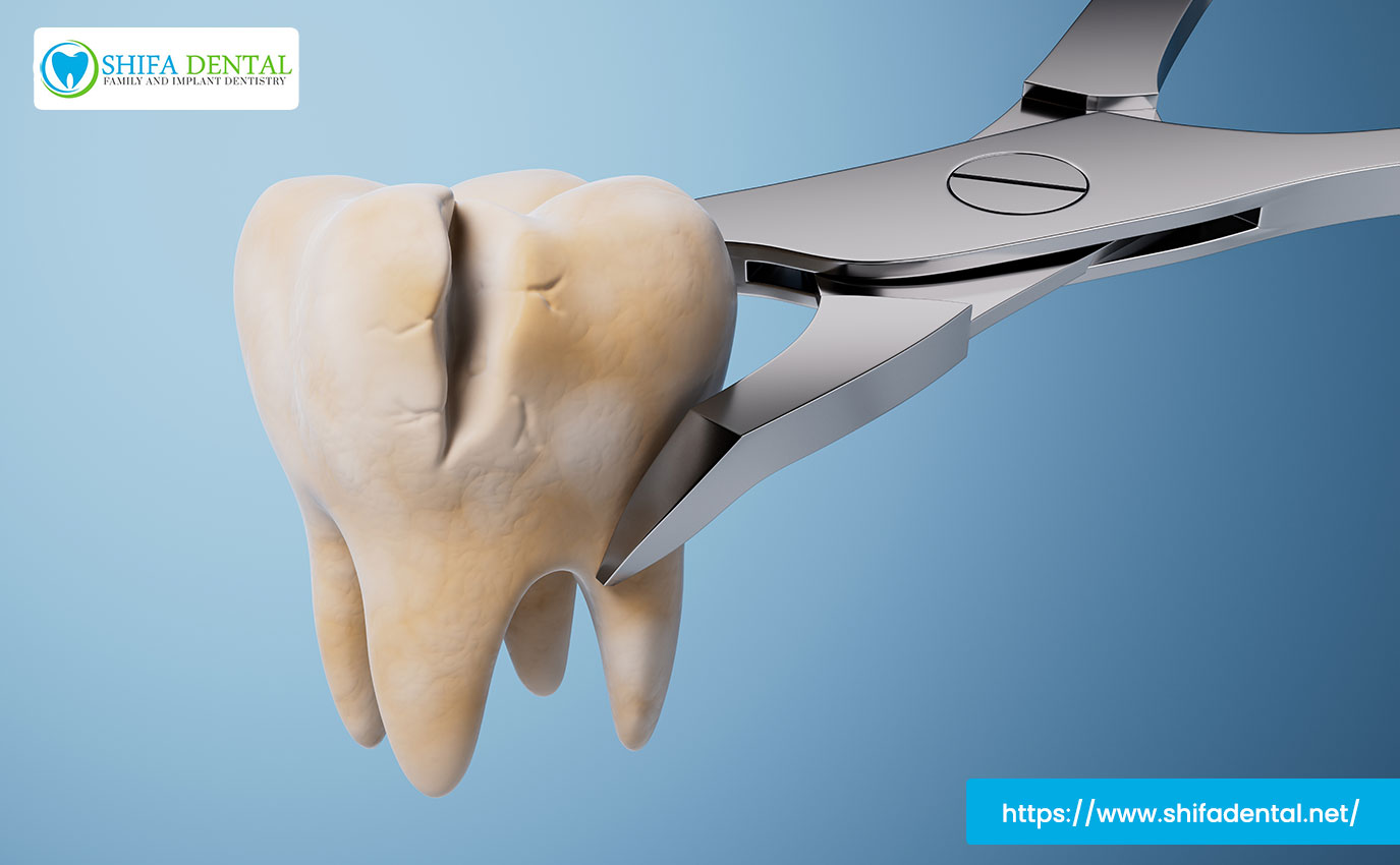 full-mouth-tooth-extraction