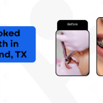 Crooked Teeth in Garland, TX