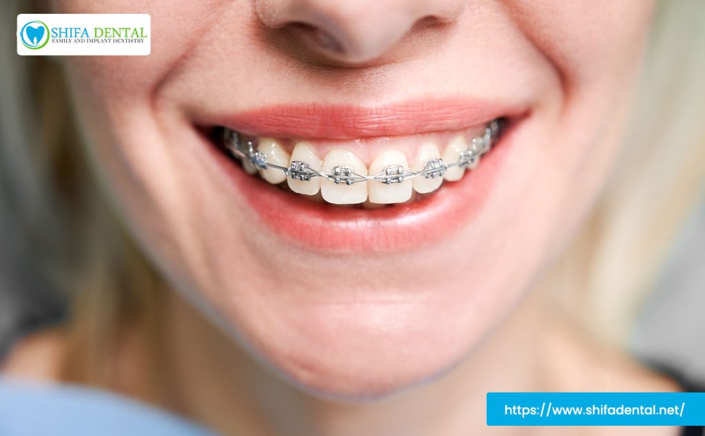 overbite treatment
