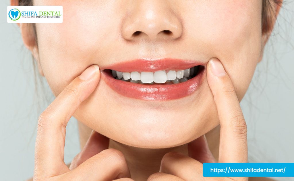 teeth-whitening