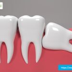 tooth-extraction