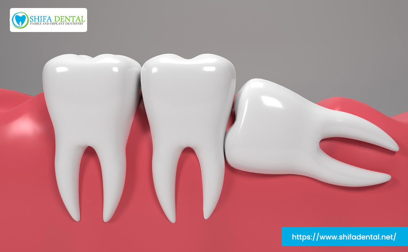 tooth-extraction
