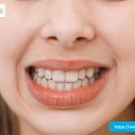 what is an overbite