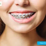 Braces for Crossbite Garland