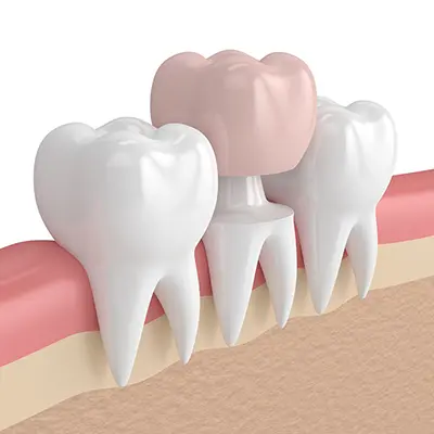 Dental Crowns
