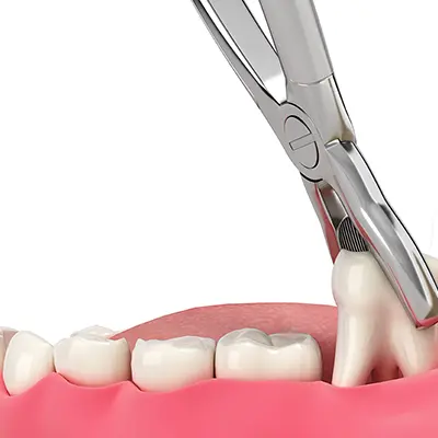 Dental Extractions