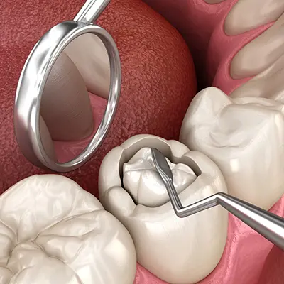 Dental Fillings