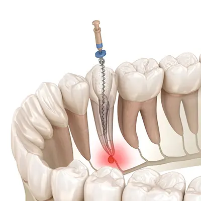 Root Canal Therapy