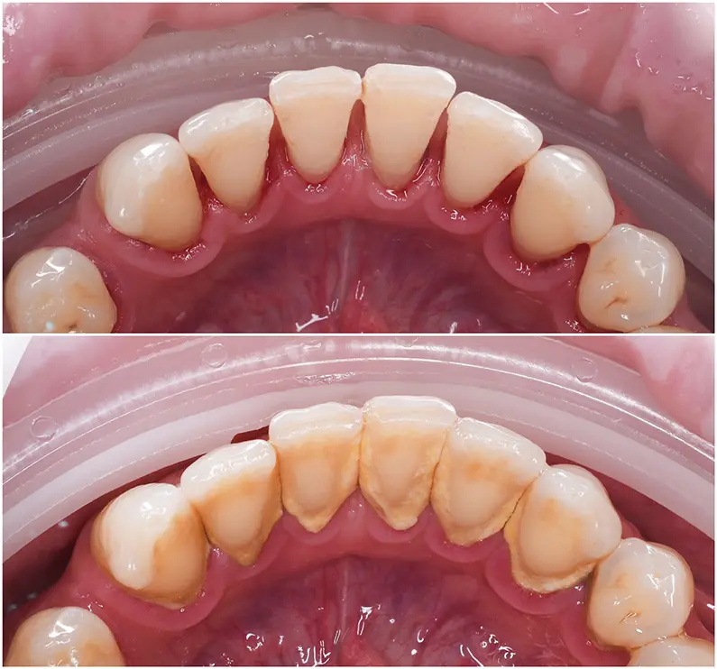 Same Day Teeth Cleaning
